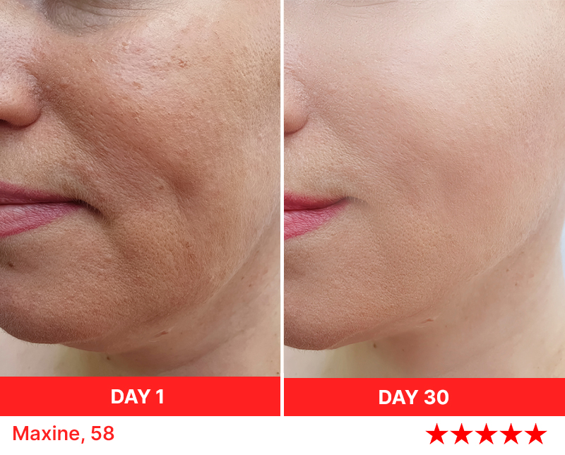 light therapy day 15