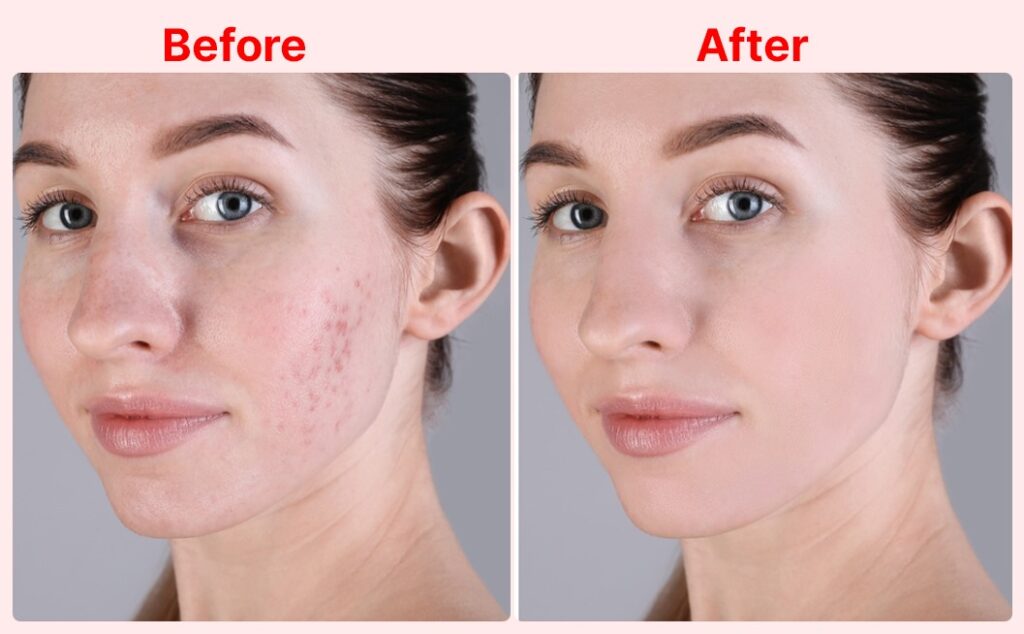 red light therapy for skin