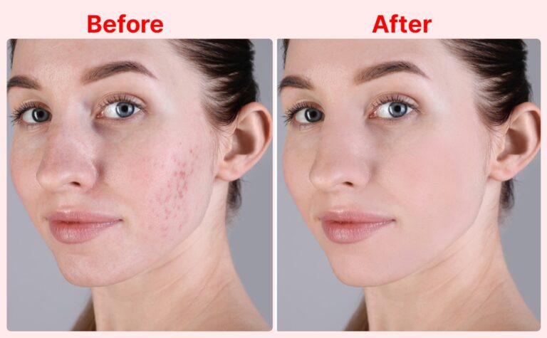 red light therapy for skin